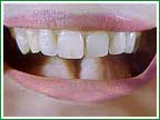 Dientes de repuesto por demanda