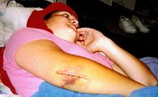 OUCH! BROKEN ELBOW