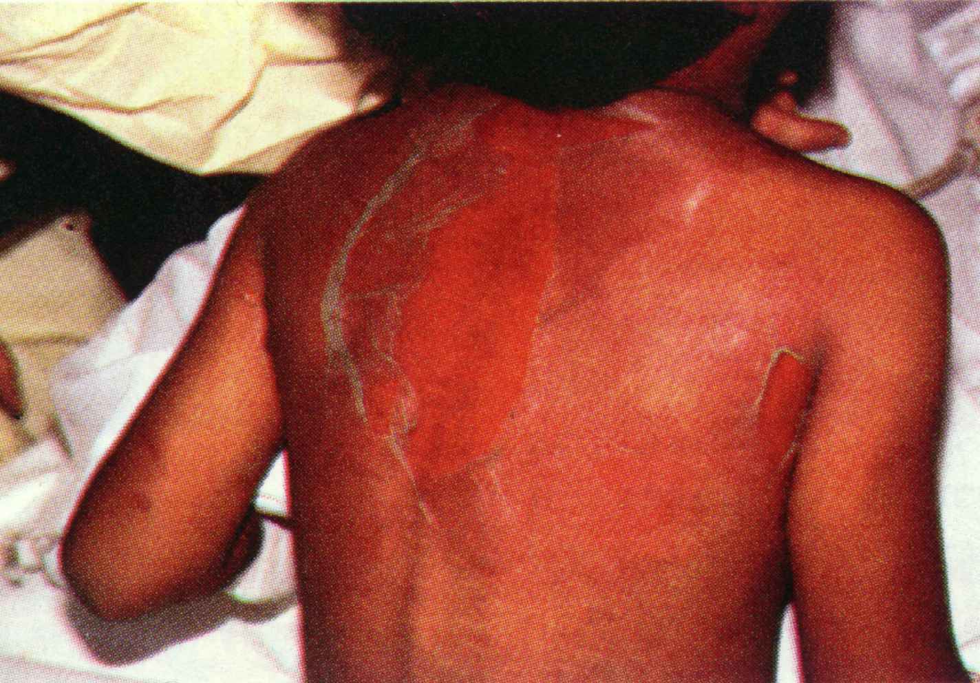 Staphylococcal ...