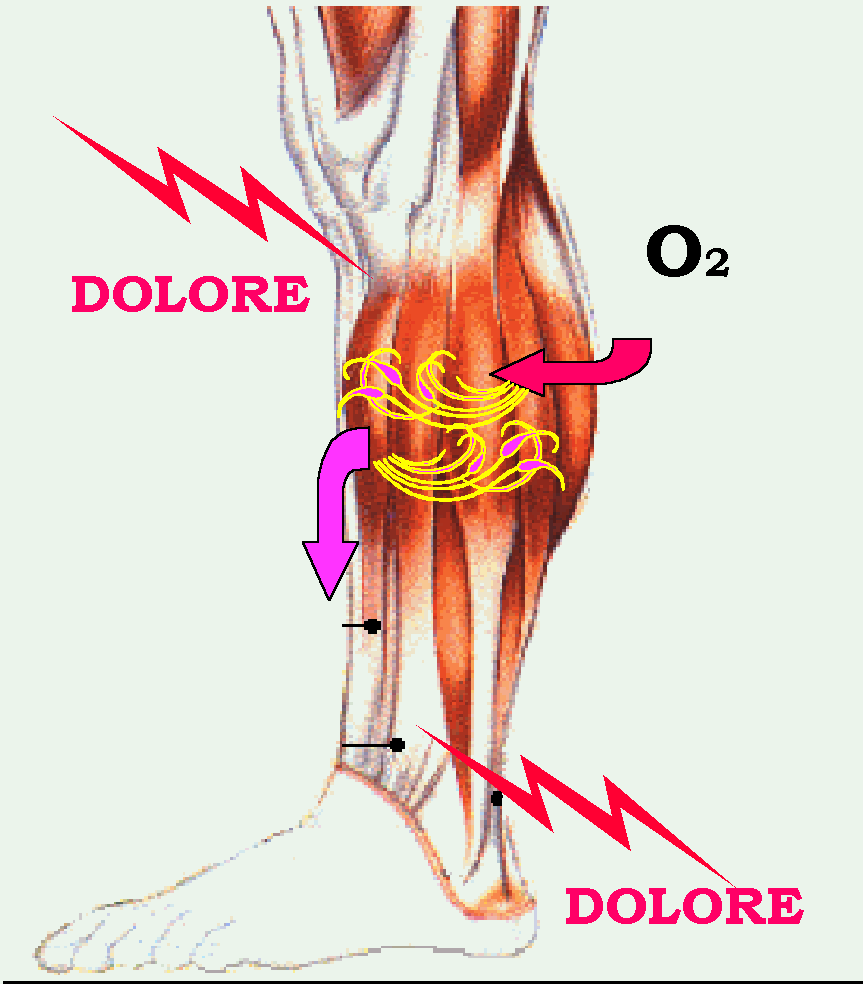Muscolo teso e stanco che non permette al sangue di circolare e genera dolore ed impotenza funzionale