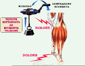 Muscolo eccessivamente sollecitato, soffre e genera dolore