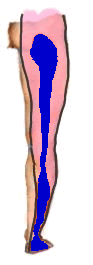 La sciatica, e l'area dolente