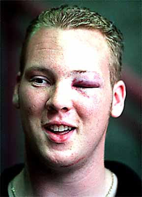 Trevor Rudniski with a black eye from Ryan Flinn