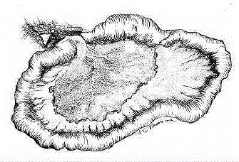 Repair Intestinal Atresia