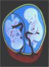 Twins in Utero