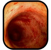 The IBD Sufferers Webring's Previous
Website