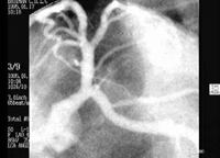 Left Coronary Artery