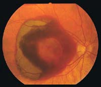 Angiogram of Wet MD eye