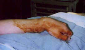 Busted up wrist