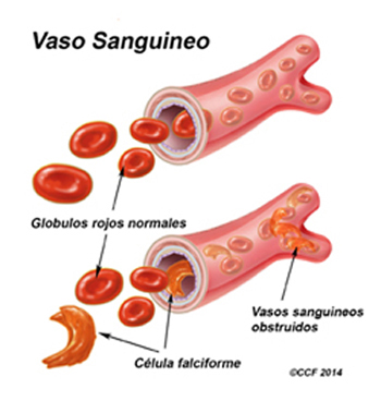 sick cell anemia