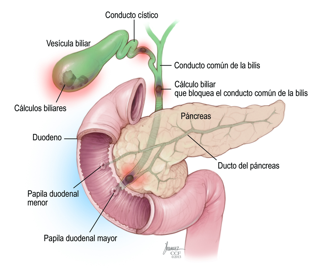 Cholecystitis_pancreas anatromy_spanish