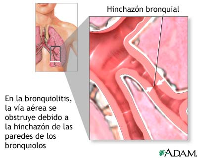 Anatomía de la Bronquiolitis