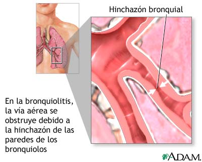 Anatom�a de la Bronquiolitis