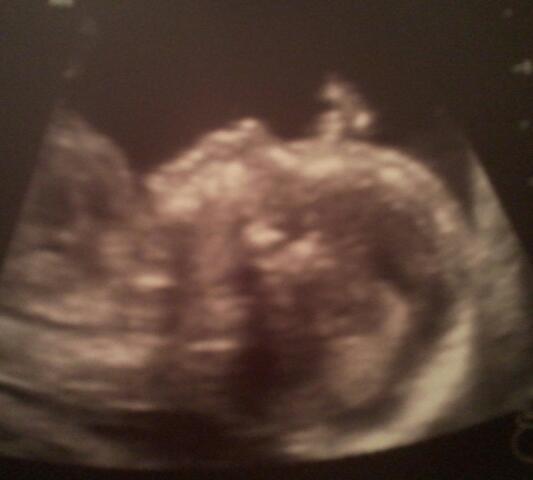 Ultrasound