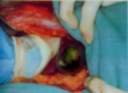 colecistitis.jpg