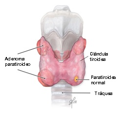 Adenoma on parathyr