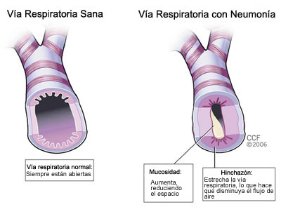 airway