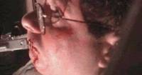 [Bob gets lips stapled]