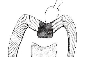 Avoid carving from amalgam to tooth structure - carve parallel to the cavosurface margins or from tooth structure toward amalgam