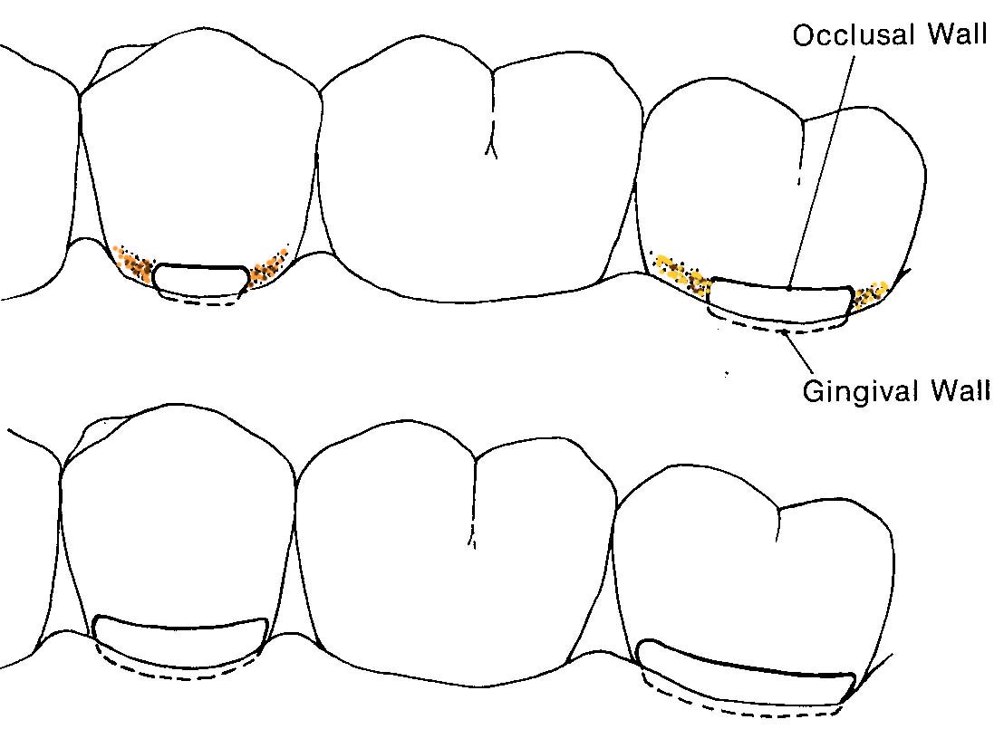 Incipient lesions may also be treated by remineralization, smoothing, polishing, & fluoride treatment
