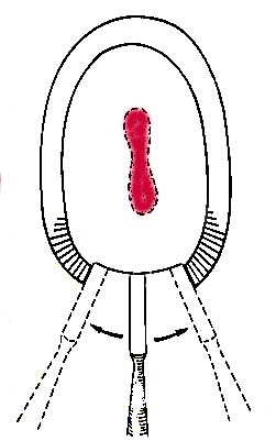 Divergent mesial and distal walls do NOT provide retention form