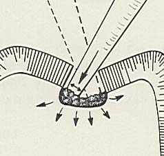Overlap strokes for complete condensation