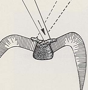Make sure amalgam is always underneath the condensor point