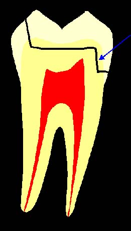 The contra-angle Tofflemire retainer is used on which side of the tooth?