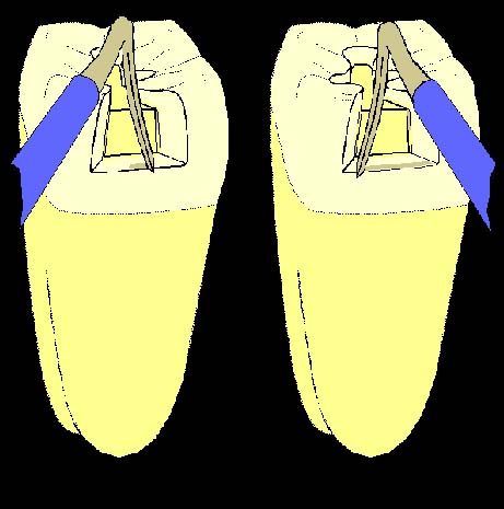 After removal of the matrix band after condensation, immediate carve the interproximal surface