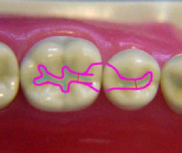 S-curves are dictated by the tooth's anatomy and contact relationship with the adjacent tooth
