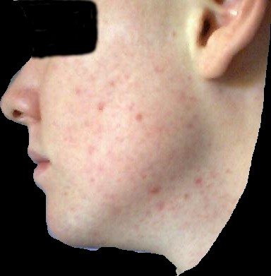 100 days of b5 treatment
