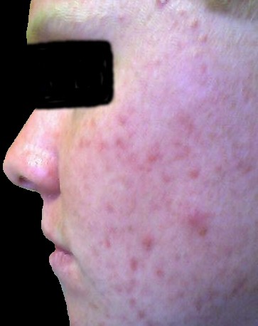 16 days of b5 treatment