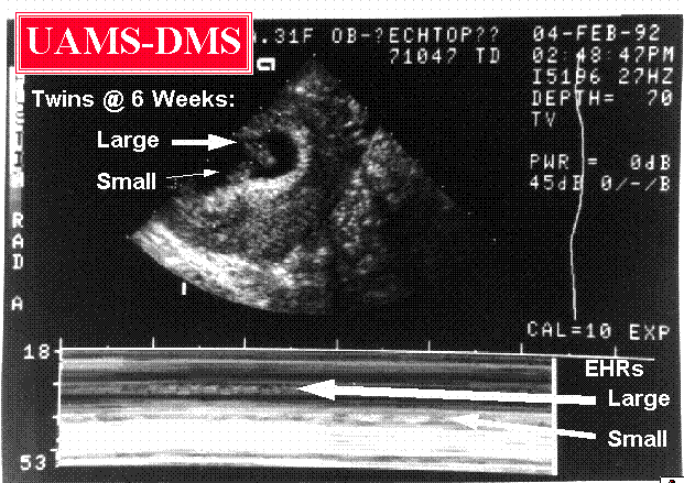 Fetal Heart Rate Chart Gender