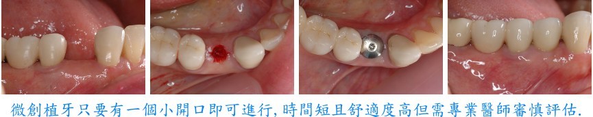 �L�дӤ� Flapless Dental Implant Service