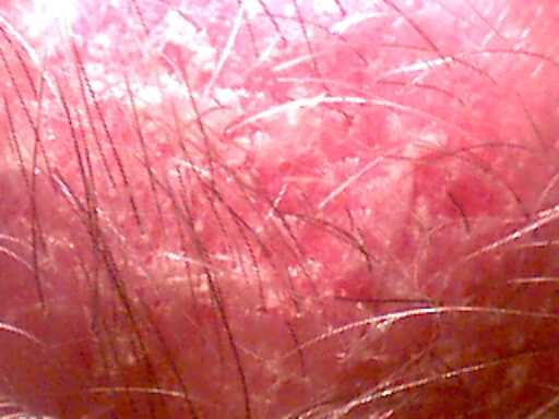 scalp3 (20K)