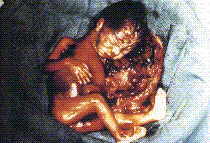 Aborto: Fotos reales