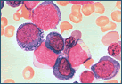 Leucemia