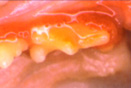 Moderate Gingervitis
