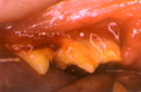 Severe Gingervitis