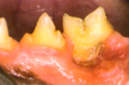 Periodontal Disease