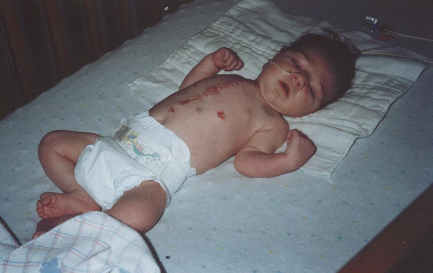 Jason, 2 weeks after surgery