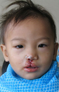 post-op