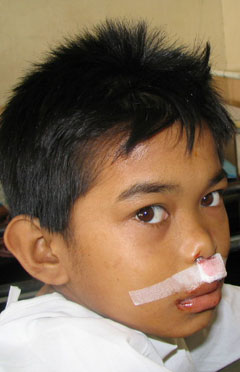 post-op
