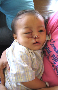 post-op