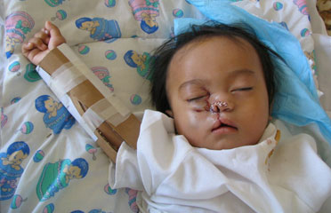 post-op