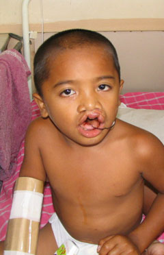 post-op