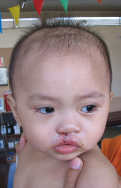 post-op