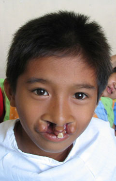 pre-op