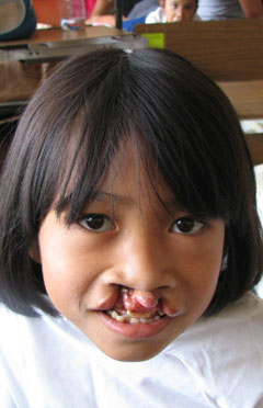 pre-op
