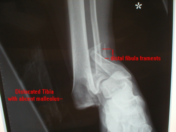 1st x-ray